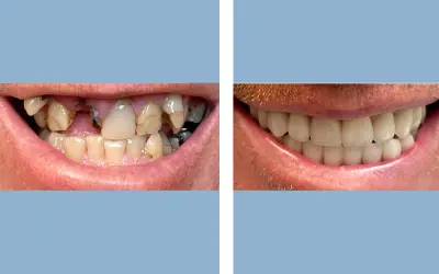 Before and After